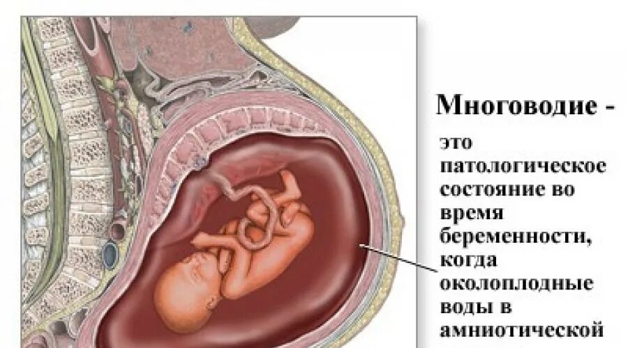 Многоводие беременность. Осложнения при многоводии.