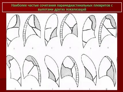 Осумкованный плеврит