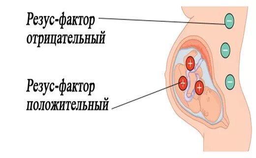 Отечная форма гемолитической болезни новорожденных. Гемолитическая болезнь новорожденных резус фактор. ГБН по резус фактору у новорожденных. Резус фактор болезни