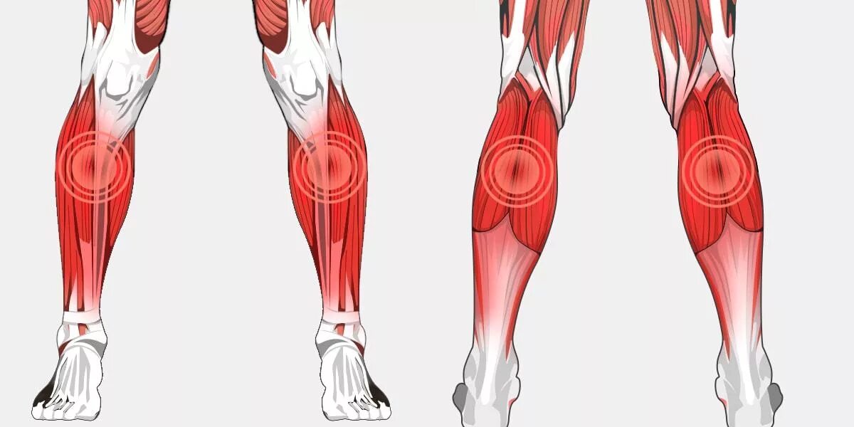 Вены икроножной мышцы анатомия. Миозит камбаловидной мышцы голени. Ноги боль икроножная мышца. Варикоз икроножная мышца.