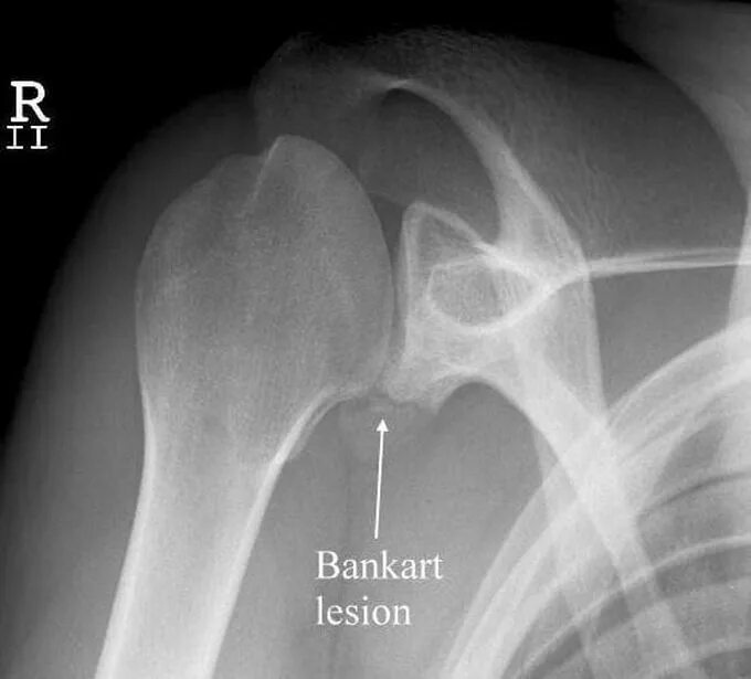 Дисплазия плечевого сустава рентген. Перелом Хилл-Сакса плечевой. Перелом Хилл-Сакса плечевой кости. Повреждение Банкарта операция и Хилл-Сакса плечевого сустава.