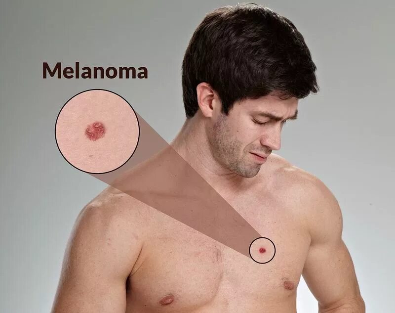 Симптомы рака груди у мужчин. Злокачественные опухоли кожи. Злокачественные кожные новообразования.