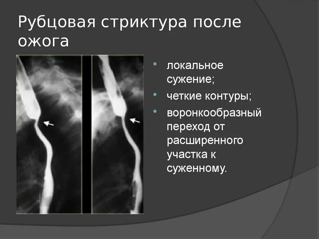 Рубцовые сужения пищевода