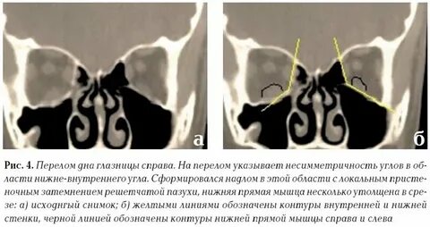 Ответы на тесты нмо перелом дна глазницы