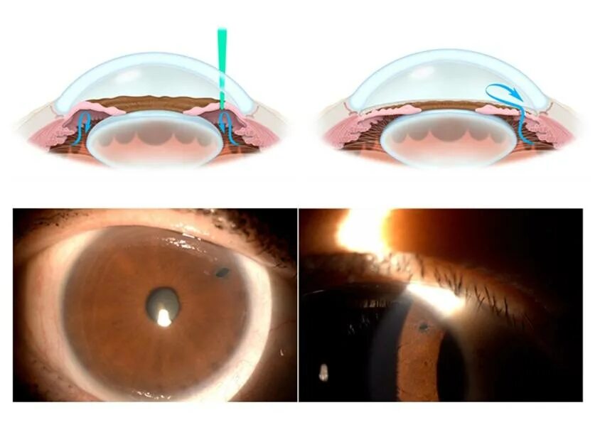 Операция лазерная иридэктомия. Периферическая лазерная иридотомия. Лазерная иридотомия при глаукоме. Лазерная периферическая иридэктомия (глаукома). Глаукома суть операции