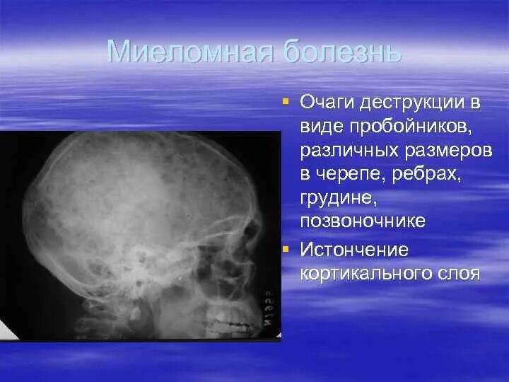 Очаговые изменения костей. Миеломная болезнь рентген черепа. Миеломная болезнь костей черепа. Миеломная болезнь висцеральная форма. Миеломная болезнь кости.