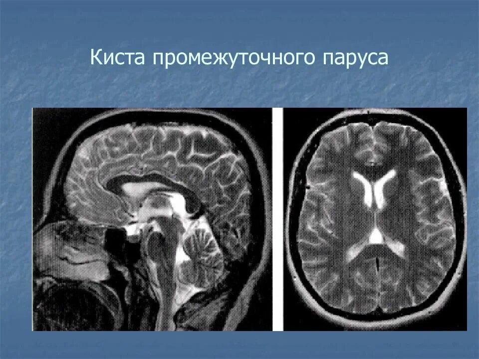 Киста головного мозга причины. Киста промежуточного паруса головного мозга кт. Арахноидальная киста промежуточного паруса. Аномалия Арнольда-Киари УЗИ плода.