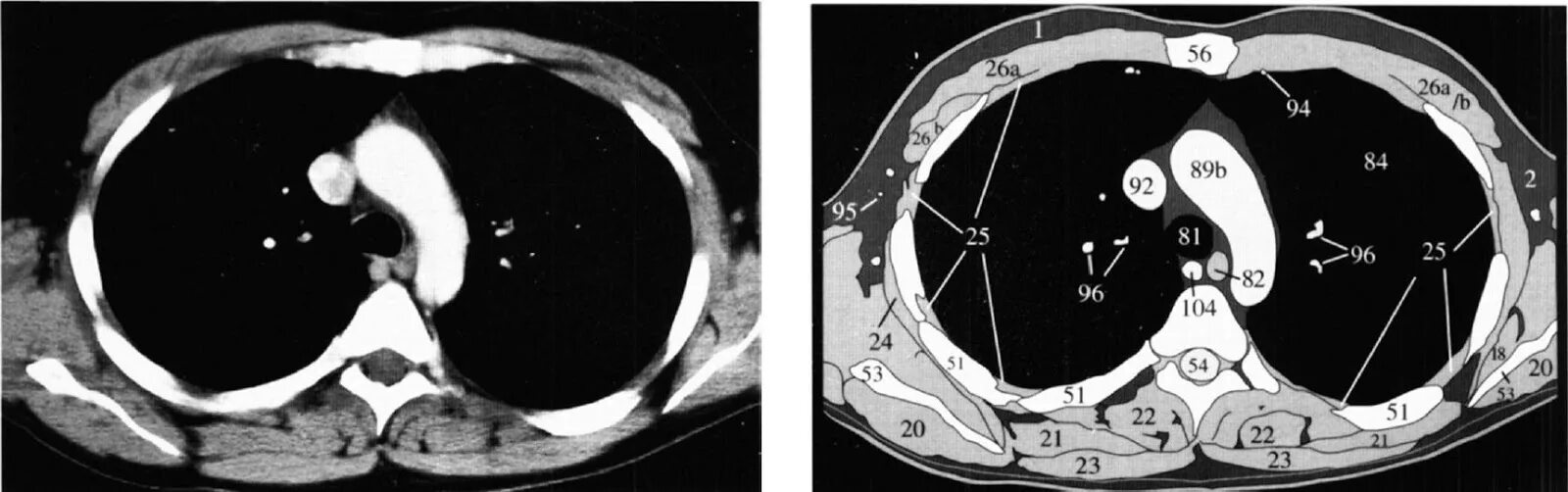 Кт легких аксиальный срез. Кт срезы брюшной полости. Срезы кт. Лимфогранулематоз мрт. Анатомия поясничного позвонка на кт.