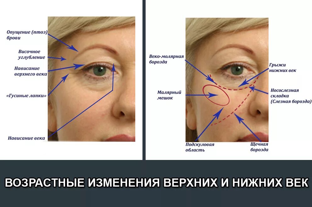 Зона глаз. Малярный мешок слезная борозда. Коррекция носослезной борозды схема. Возрастные изменения периорбитальной зоны. Анатомия носослезной борозды.