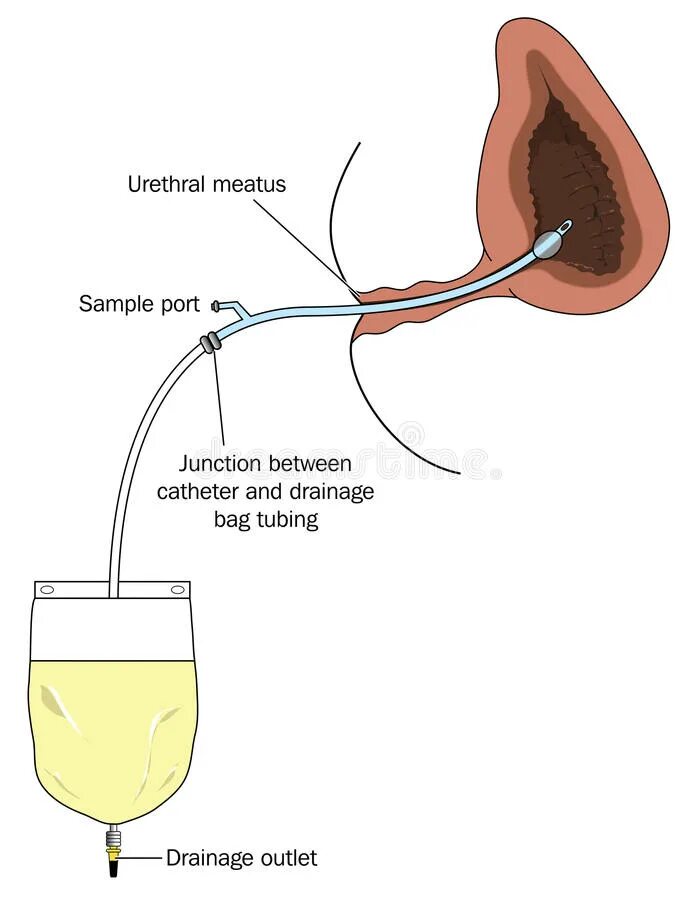 Катетер не идет моча. Мочевой пузырь urine bladder. Исследование мочевого пузыря катетером. Катетер для отвода мочи мужской.