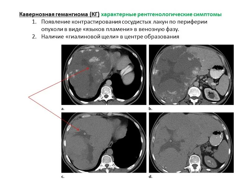 Образования печени кт. Кавернозная гемангиома печени мрт. кавернозная гемангиома печени кт. гемангиома печени мрт т2. атипичная гемангиома печени на кт.