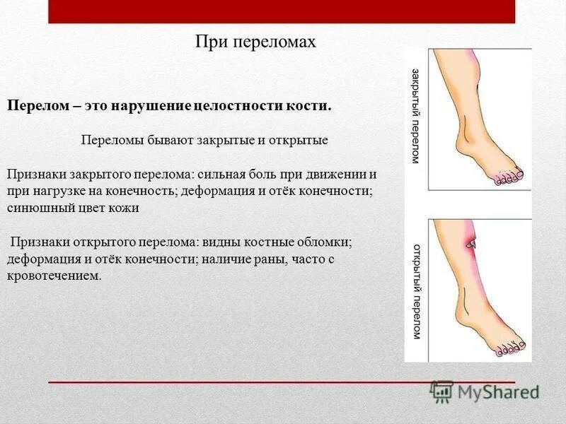 Симптомы открытых и закрытых переломов. Переломы костей конечностей. Перелом симптомы и признаки. 1 признаки перелома