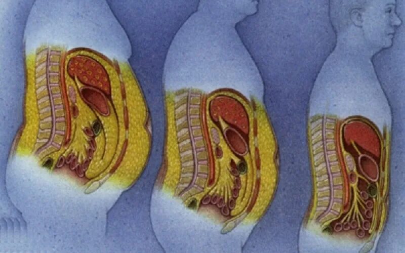 Толстый под жиром. Ожирение внутренних органов. Человеческий жир в разрезе.