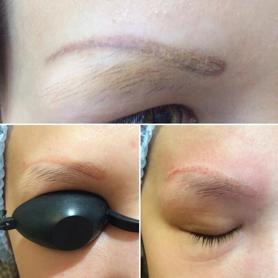 перманентный макияж бровей лазером. сведение бровей лазером. сведение перманентного макияжа бровей. перманентный макияж зеленоград. перманентный макияж зеленоград.