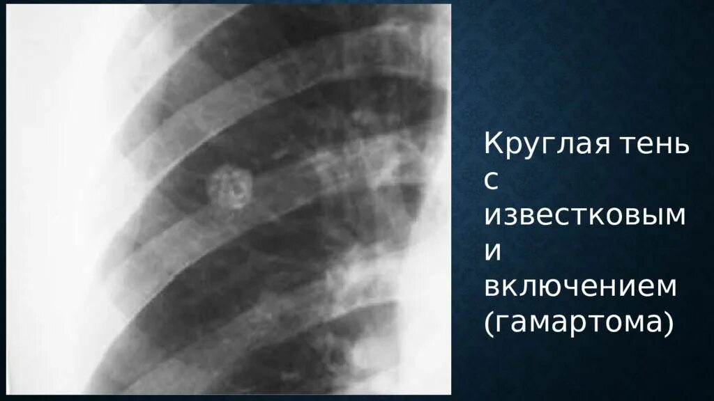 Пятно в легком что это может быть
