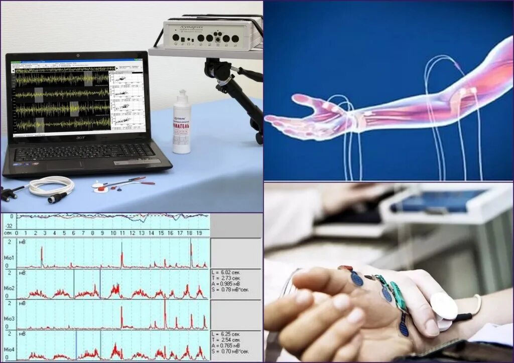 электронейромиография (энмг). стимуляционная электронейромиография нижних конечностей. энмг стимуляционная. электромиография (эмг). электромиография нижних конечностей.