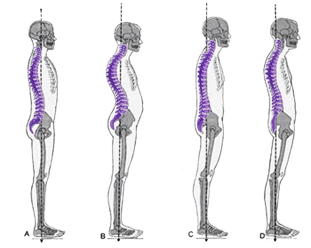 Кифоз сколиоз позвоночника. Лордоз грудного отдела кифоз поясничного. Искривление позвоночника гиперлордоз. Сглажен лордоз в поясничном отделе позвоночника. Правильная поясница