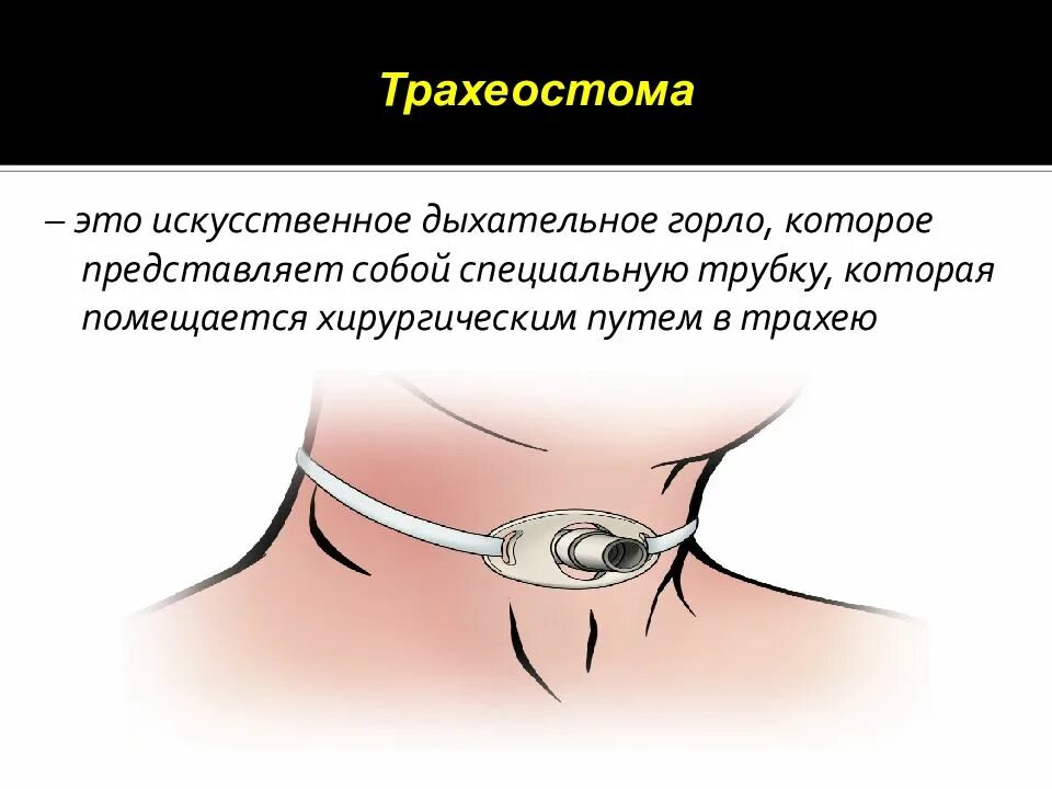 Трахеостома памятка. Памятка правила ухода за трахеостомой. Воспаление вокруг трахеостомы. Уход за трахеостомой алгоритм сестринское дело