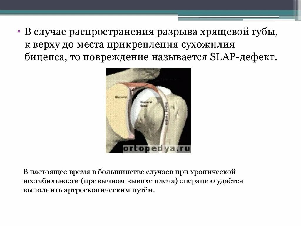 Привычный вывих мкб