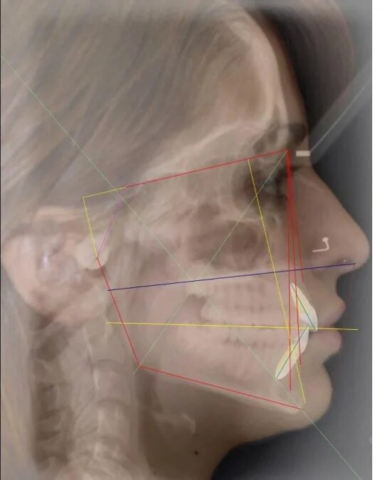 Антропометрические точки трг. Цефалометрия внчс. Planmeca romexis рентген. 3д цефалометрия челюстей. Цефалометрия в ортодонтии.