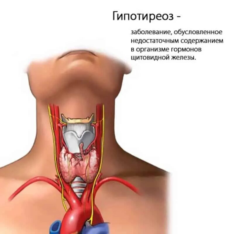 Можно ли с проблемами щитовидной. Гипотиреоз щитовидной железы. Гипотиреоз щитовидной железы симптомы. Болезнь щитовидной железы гипотиреоз. Воспаление щитовидной железы гипотиреоз.