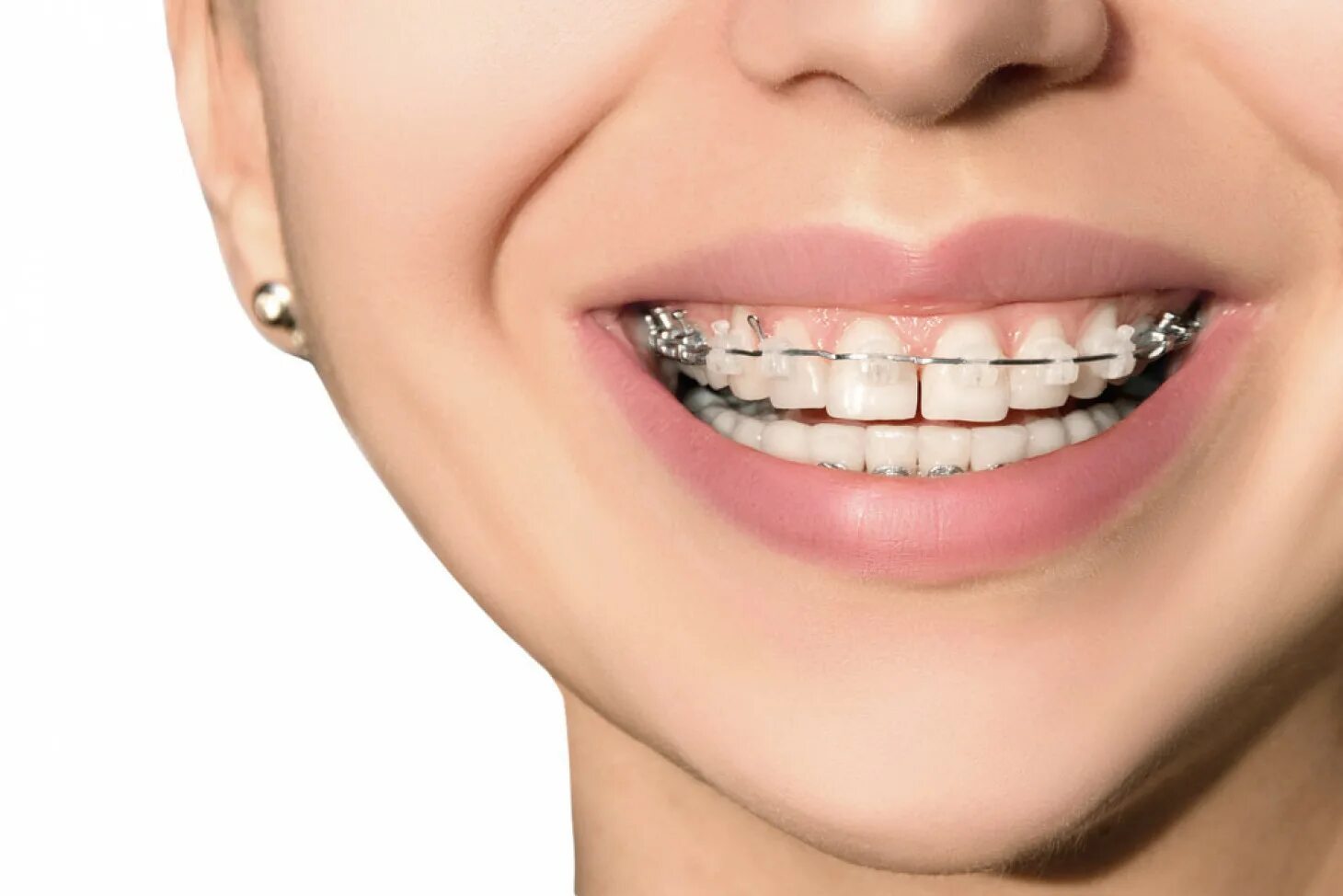 Brackets photo