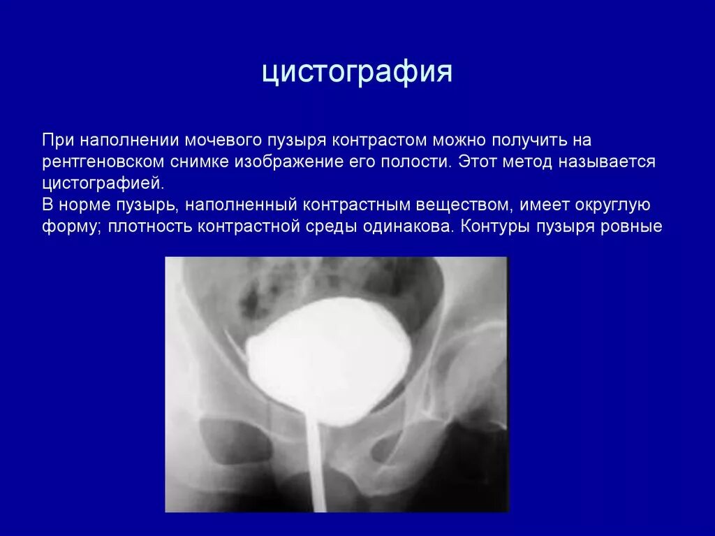 Цистография мочевого пузыря рентген. Контрастирование мочевого пузыря рентген. Ввод контрастного вещества в мочевой пузырь. Цистография нисходящий метод. Опухоли введение