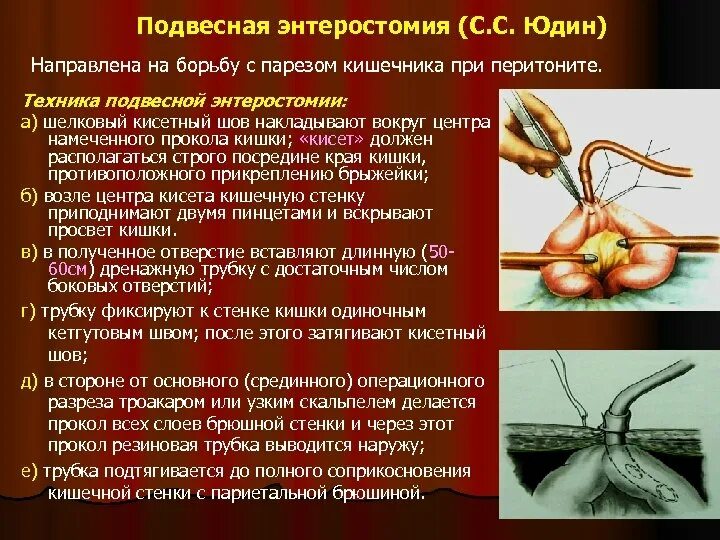 Еюностома это