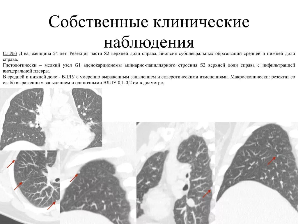 Лимфатические узлы легких. Очаговых изменений правого легкого