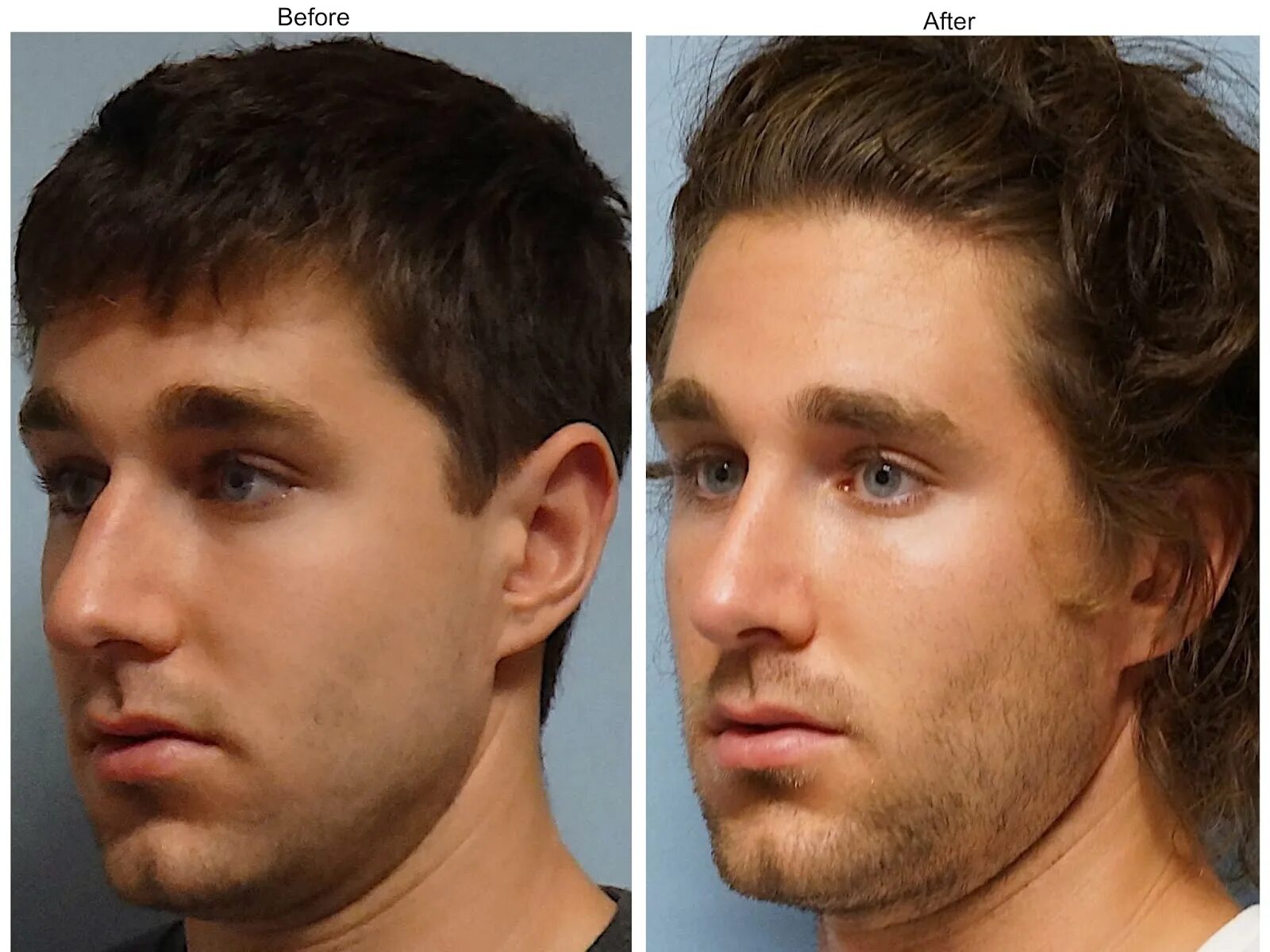 Мужчин характер подбородок. Нос мужской. Мужской подбородок. Операция на нос до и после мужчины.