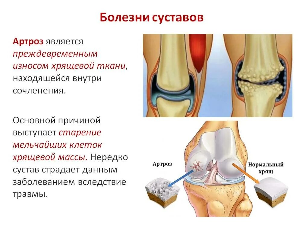 Эффективное лечение артроза сустава. Разрушение хрящевой ткани коленного сустава. Хрящевая ткань коленного сустава. Артрит артроз остеоартроз. Артроз коленного сустава.