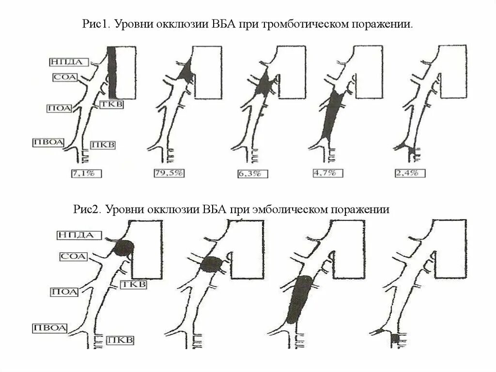 Уровень окклюзии