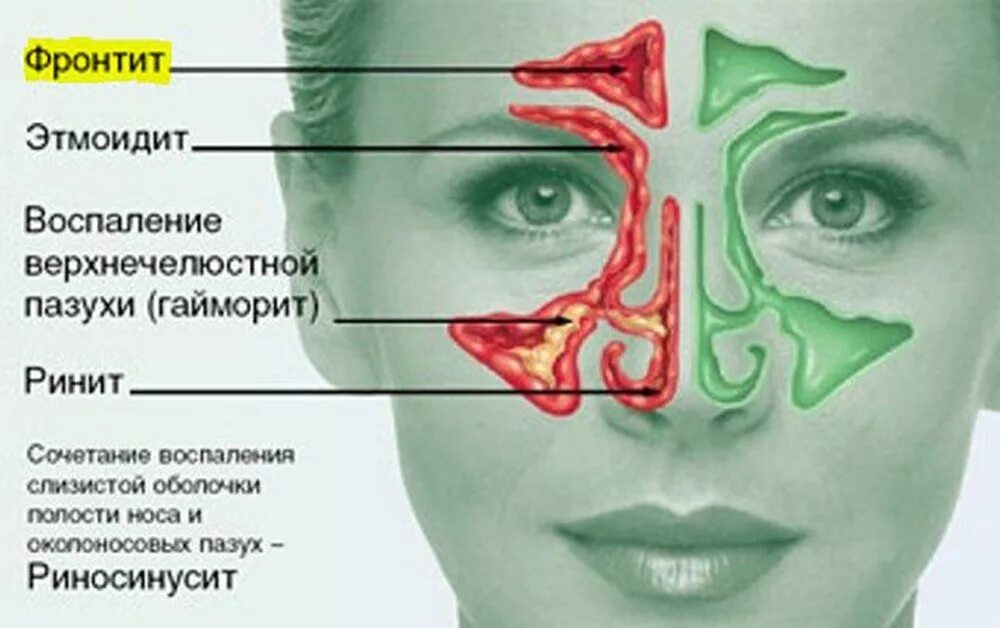 Причины заболевания носа. Синусит придаточных пазух. Заболевания оклоносныхпазух.