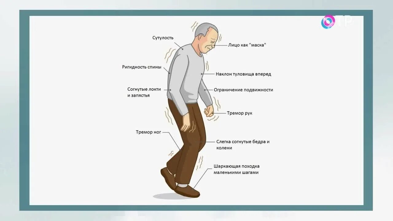 Болезнь Паркинсона. Симптомы Паркинсона. Болезнь Паркинсона симптомы. Левин болезнь Паркинсона. Лечение болезни паркинсона москва
