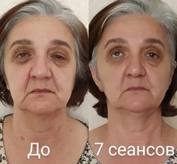 Витапластика лица что это такое отзывы