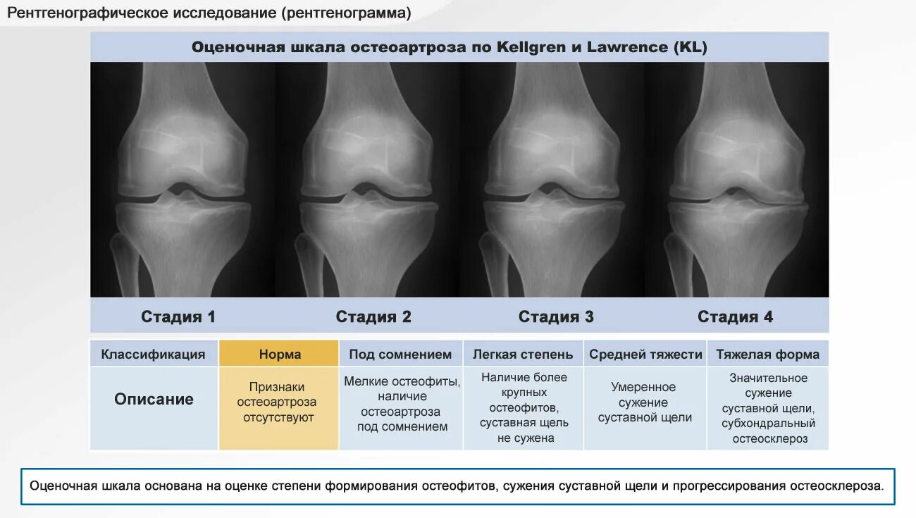 Остеоартроз коленного сустава степени рентген. Степени артроза коленного сустава на рентгене. Рентгенологические стадии артроза коленного сустава. Гонартроз степени рентгенологические.