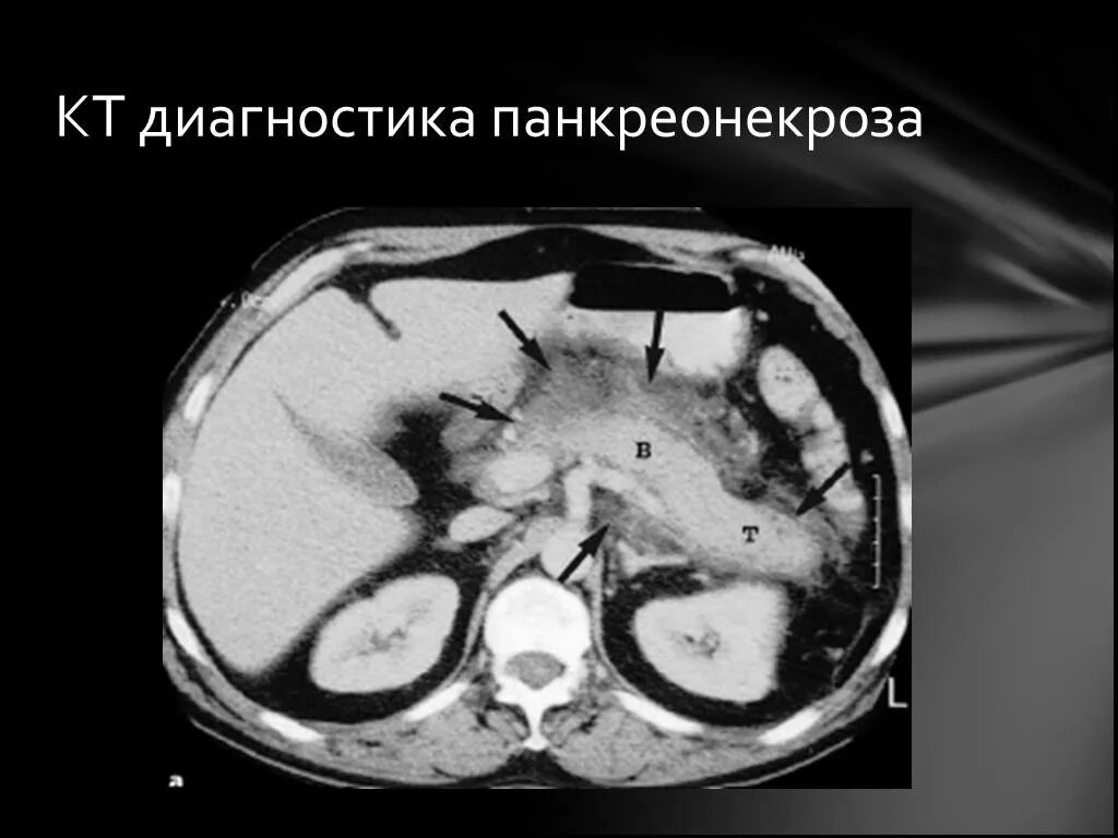 Что такое некроз поджелудочной железы у мужчин. Панкреонекроз поджелудочной на кт. Некроз поджелудочной железы кт. Панкреонекроз макропрепарат. Инфицированный панкреонекроз кт.