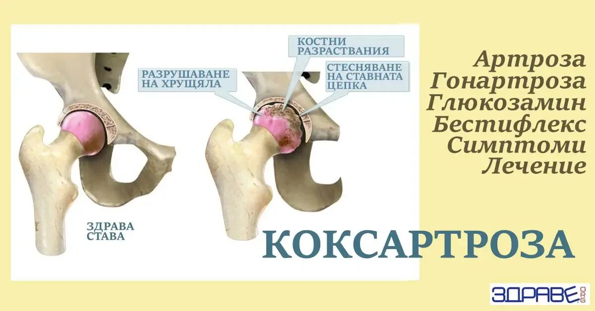 Коксартроз тазобедренного 3-4 степени. Коксартроз 2 операции. Коксартроз тазобедренного сустава. Протрузионный коксартроз.