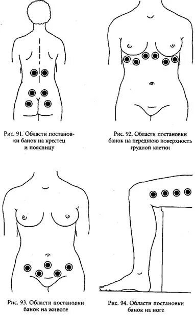Банки при болях в спине. Вакуумные банки схемы установки. Схема баночного вакуумного массажа. Баночный массаж спины схема постановки банок. Вакуумные банки на поясницу схема.