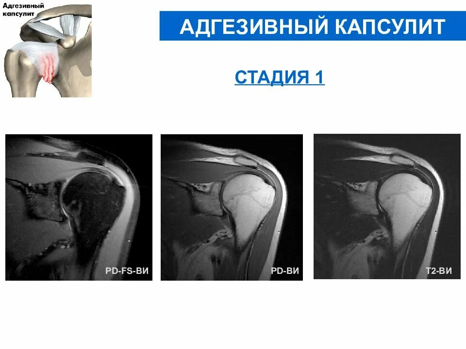 Адгезивный капсулит плечевого сустава мрт. Адгезивный капсулит стадии. Адгезивный капсулит плечевого сустава кт. Плечелопаточный периартрит мрт.