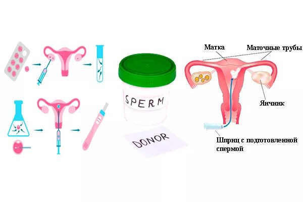 Донор для зачатия. Набор для инсеминации. Внутриматочная инсеминация (ВМИ). Шприц для искусственной инсеминации. Набор для домашнего оплодотворения.