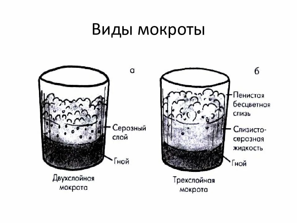 Мокрота определение. Слоистость мокроты при туберкулезе. Три слоя мокроты. Три слоя мокроты при абсцессе. Схема вид мокроты.