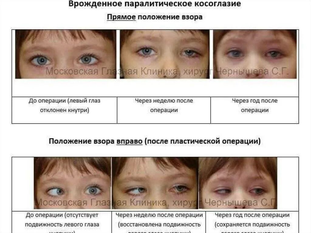 Косит глаз причины. Содружественное и паралитическое косоглазие. Симптомы паралитического косоглазия. Паралитическое косоглазие у детей. Косоглазие у детей фото.