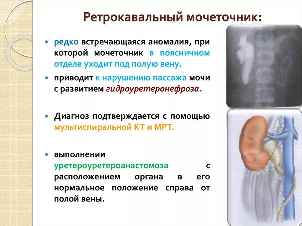 Развитие мочеточников. Ретрокавальный мочеточник. Ретрокавальное расположение мочеточника. Пороки развития мочеточника. Аномалии структуры мочеточников.