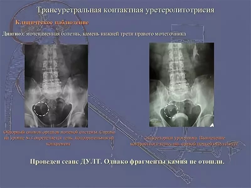 Конкремент мочеточника рентген. Конкремент в нижней трети мочеточника рентген. Конкремент н 3 правого мочеточника. Камень средней трети мочеточника.