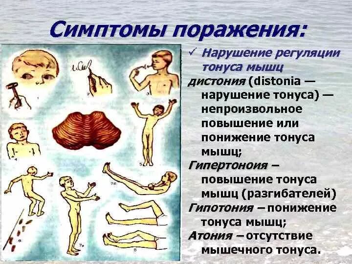 Мышечная дистония код