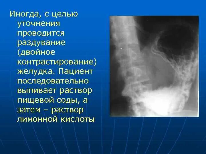 Исследования пищевода и желудка. Рентгеноанатомия пищевода. Рентгеноанатомия желудка. Методики рентгенологического исследования желудка. Отделы желудка рентгеноанатомия.