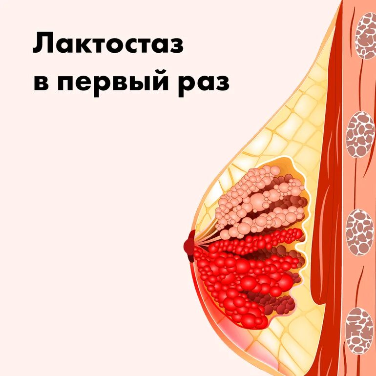Что такое лактостаз. Лактостаз. лактостаз молочной железы.