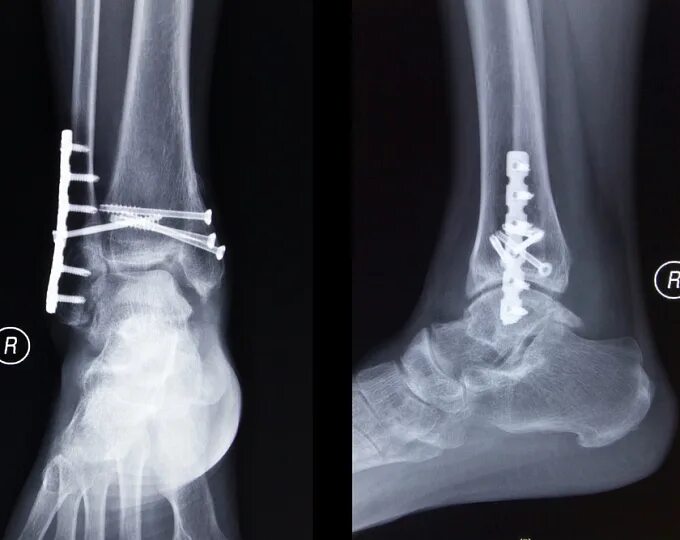 Перелом голеностопного сустава. Перелом голеностопного сустава рентген. S82.6 - перелом наружной [латеральной] лодыжки. Перелом голеностопа рентген. Перелом лодыжек голеностопного сустава рентген.