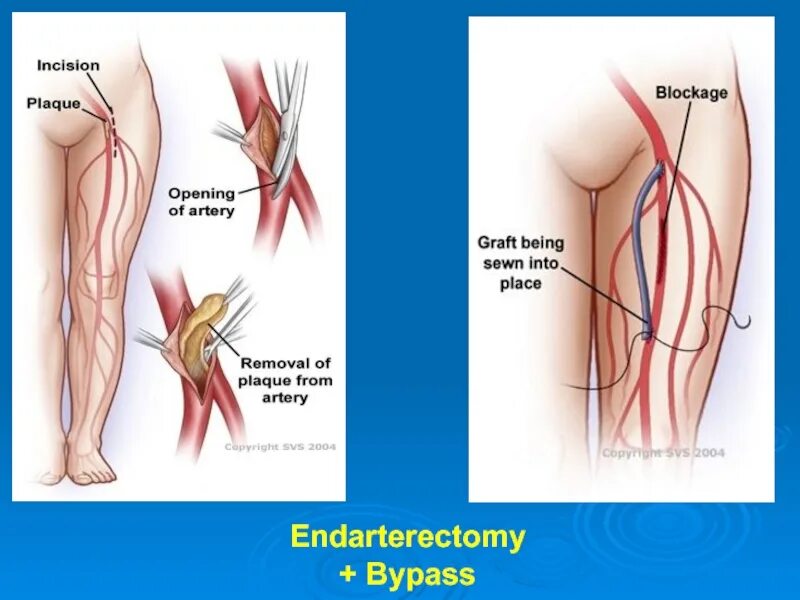Эндартерэктомия нижних конечностей. Эндартерэктомия закрытая нижней конечности. Эндартерэктомия это